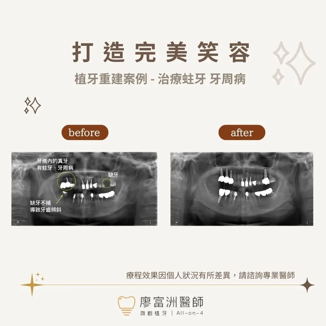 案例分享✨牙周病治療
