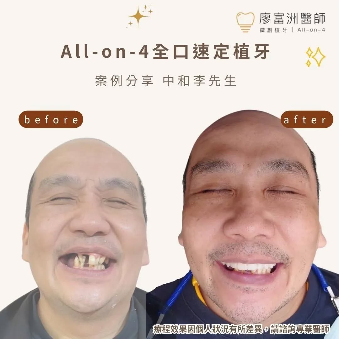 案例分享✨速定植牙，帶你走向完美笑容的捷徑❗