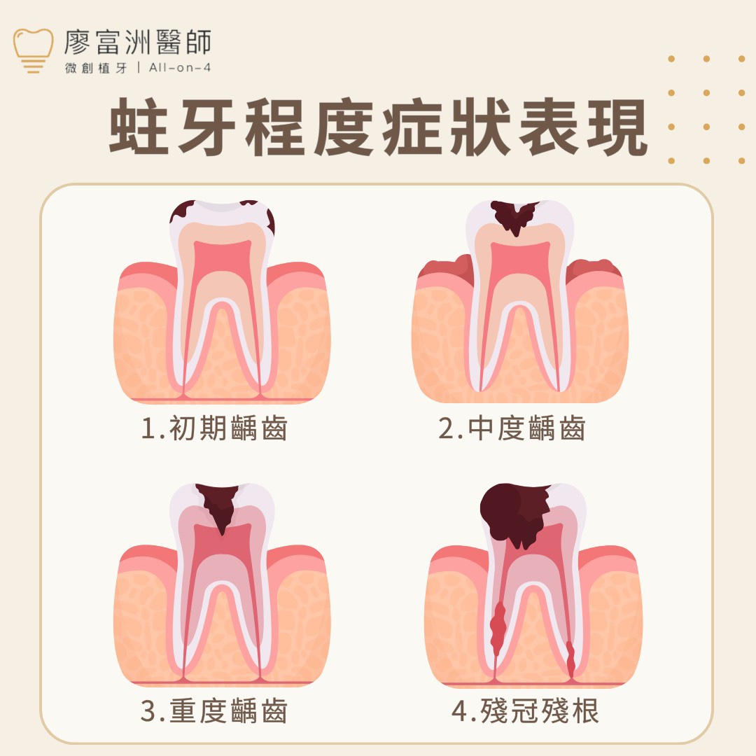 蛀牙症狀如何注意❓及早發現才能及早治療❗
